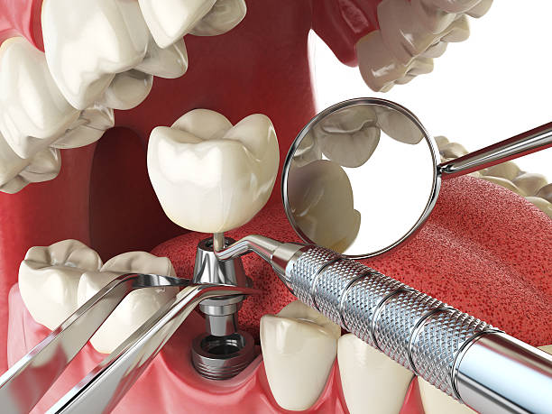 Best Emergency Root Canal Treatment in Cypress Quarters, FL